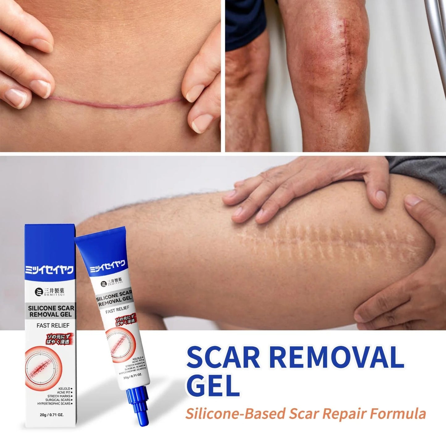 Silicone Scar Gel for Old and New Scars